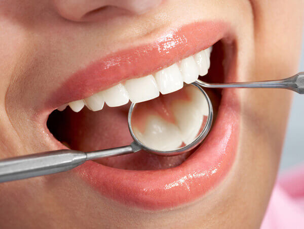 Why Porcelain Veneers?